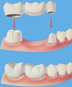 dental_bridges