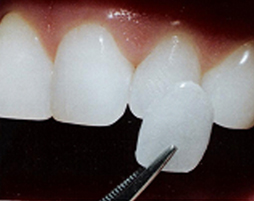 porcelain veneers