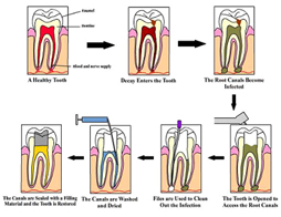 root_canal_treatment